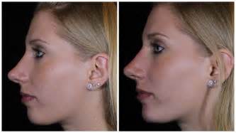 Enhance Your Facial Aesthetics with Magic Nose Shaping